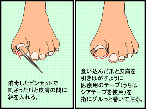 軽い巻き爪になった時の処置方法と爪にまつわる方言 としごと しごとと